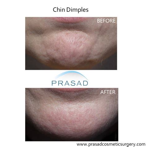 Chin Augmentation | Chin Implant by Dr Amiya Prasad New York