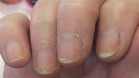 Nail Damage during Treatment for Breast Cancer