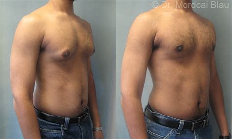 Adolescent Gynecomastia - Before and After Photos ⋆ Gynecomastia USA