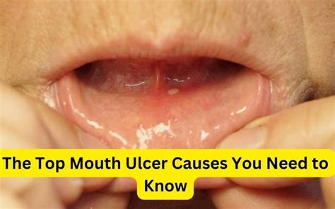 The Top Mouth Ulcer Causes You Need to Know