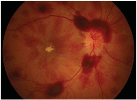 Retinal haemorrhage and optic disc swelling after subarachnoid... | Download Scientific Diagram