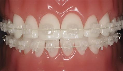 Top 5 Things to Keep in Mind When Using Clear Braces - Hello Miss Niki