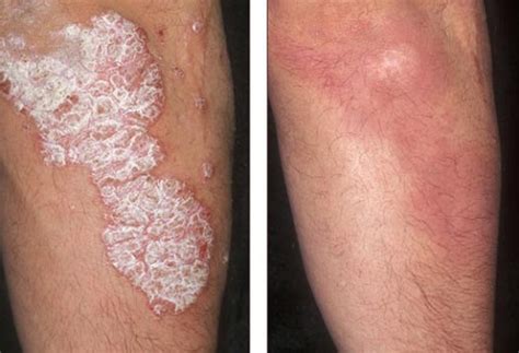 Options for Treatment of Psoriasis - Treatment of Psoriasis on Body!