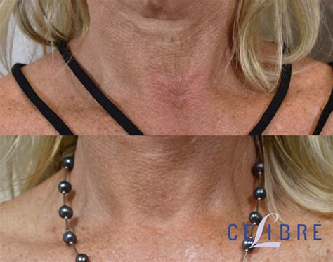 Sculptra Before and After Pictures