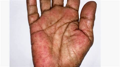 Rheumatoid Arthritis Rashes: Pictures, Symptoms, & Treatments