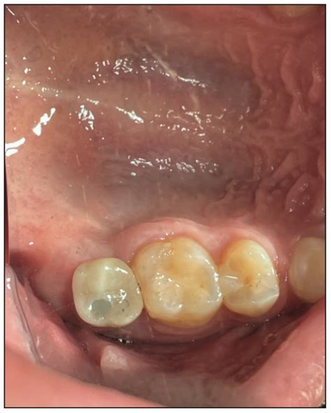 Contemporary Approach on Sinus Augmentation - Dentistry Today