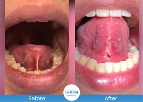 Tongue Tie Surgery Before & After Gallery in Dallas, TX