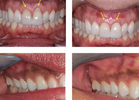 Laser Gum Treatment – Morgan & Lemke Periodontics & Dental Implants