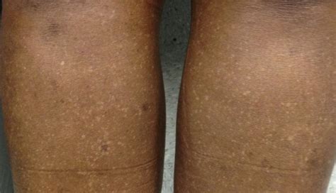 Why Am I Getting Light Spots On My Legs | Americanwarmoms.org