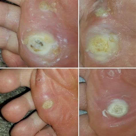 You asked. Here is my Plantar Wart progression : r/popping