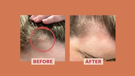 My Scalp Psoriasis Came Out of Nowhere — Here's How I Treated It | Allure