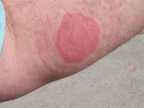 Allergic Reaction to Mosquito Bites | New Health Advisor