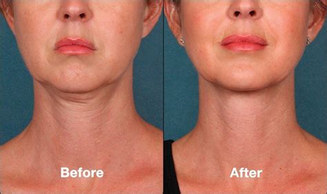 The Pros And Cons Of Kybella For Double Chin Reduction | Justinboey