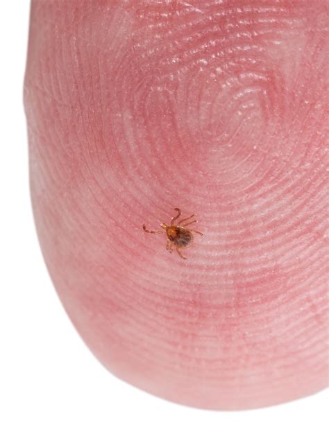 ticks on humans – how to remove a tick – Filmisfine