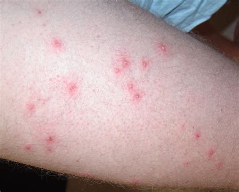 Folliculitis - Causes, Signs, Symptoms, How to Get Rid of Folliculitis