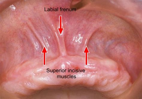 Frenum and Types or Classification of Frenal Attachments in Oral Cavity