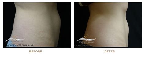 Before & After Vanquish – Newport Coast Dermatology