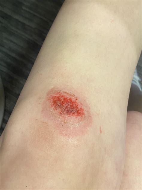 Is my knee scrape infected? : r/medical_advice