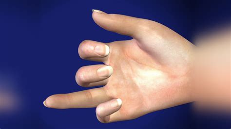 Can A Torn Finger Ligament Heal On Its Own - Robert Martin Kapsels