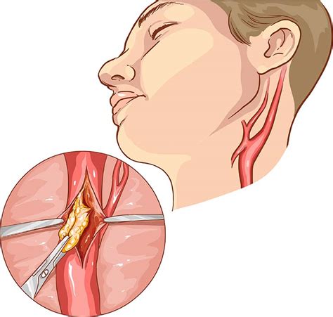 Carotid Artery Disease Treatment | Vascular Institute