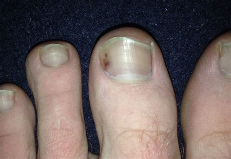 toenail melanoma pictures | Symptoms and pictures