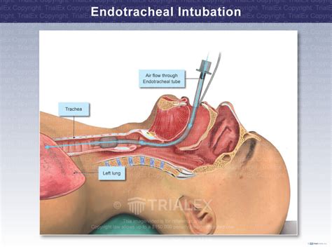 Endotracheal Intubation - Trial Exhibits Inc.