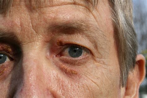 After Xanthelasma Removal - Xanthelasma Removal