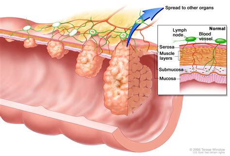 Colon Cancer Stages And Treatment