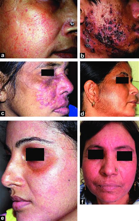 Adverse effects of topical corticosteroids on the face. (a) Marked... | Download Scientific Diagram