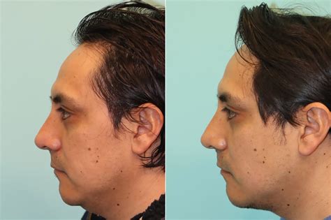 Submentoplasty photos | Chevy Chase, MD | Patient 24121