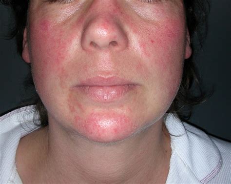 Skin Manifestations of Thyroid Disorders: A Review - Dermatology Advisor