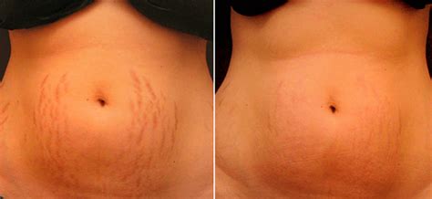 Laser Stretch Mark Removal: The Advanced Way of Removing Stretch Marks