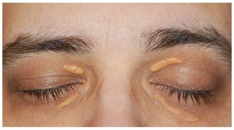 Understanding Xanthelasma: the weird yellow deposits on your eyelids!