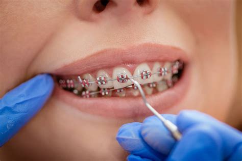 Orthodontic Braces | Dental Braces | Orthodontists in Buffalo, NY