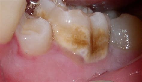 FAQ - What are hypocalcified teeth? — Discovery Pediatric Dentistry