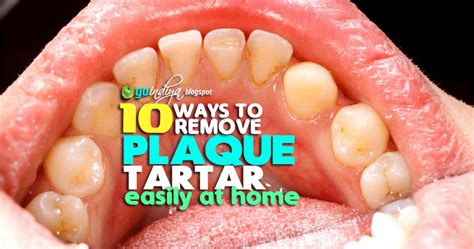 How to remove baby teeth tartar Idea | hostalelportalico