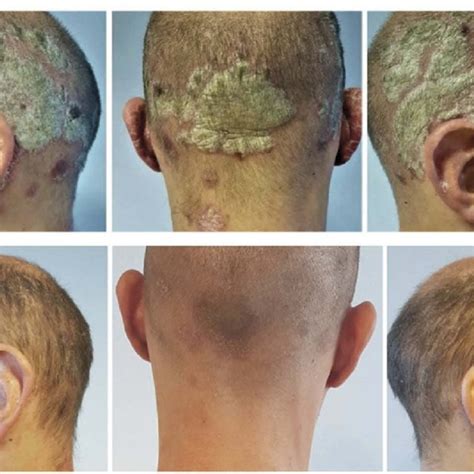 Case 2: (A) before and (B) after treatment for 4 weeks with... | Download Scientific Diagram