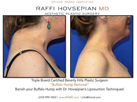 Take a look at this great before and after of a pa | Buffalo hump, Plastic surgeon, Plastic surgery
