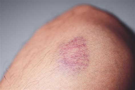 How V-Beam Can Help Treat Bruises & Other Treatment Options