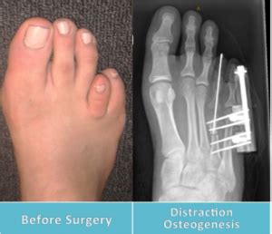 Brachymetatarsia Surgery Perth | Perth Podiatric Surgery