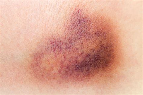 Bruises – What They Are and How to Treat - Dr. Lauri Grossman