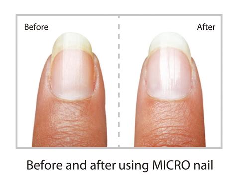 Buff and Shine Nails in just Minutes – MicroNail