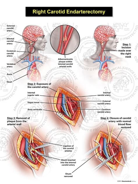 Male Right Carotid Endarterectomy