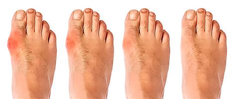 Bunion Surgery | Foot Doctor Southlake, Keller, Flower Mound, North Richland Hills, Argyle and ...