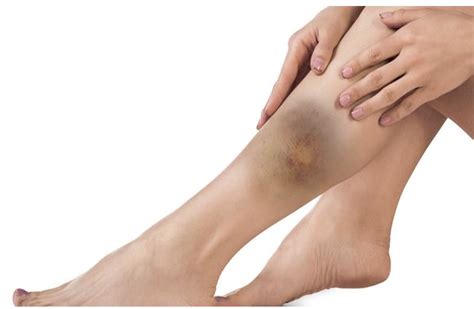 Condition Spotlight: Soft Tissue Injuries | Watsonia Podiatry