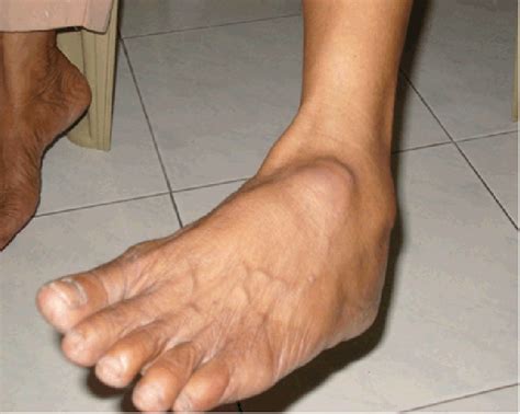 Swelling on the dorsal surface of left foot. | Download Scientific Diagram