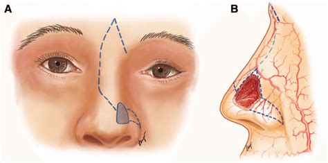 a, Frontal view of an additional myocutaneous rotation flap from the ...