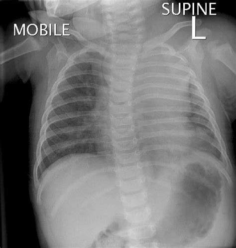 Cystic Hygroma - radRounds Radiology Network