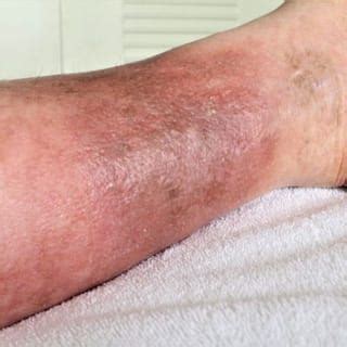 Statis Dermatitis - Hill Center For Dermatology PC | Golden, CO Dermatologist