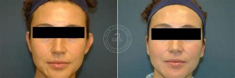 Otoplasty Photos | Miami Beach, FL | Patient 3263